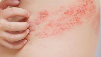 女性は19%が火傷を負う可能性が高くなりますが、なぜですか?