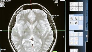 Belajar dari Peristiwa Tukul Arwana, Begini Cara Hindari Pendarahan di Otak