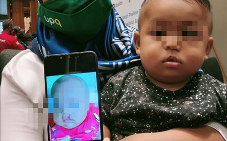 Kebaikan Warganet di SnackVideo Membuat 300 Bayi Bibir Sumbing Bisa Operasi Gratis