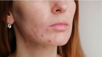 Frequent Acne In The Neck Area? Recognize The 5 Causes