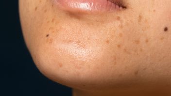 What Is Hyperpigmentation? Dark Spot On The Skin Complete By Overcoming It