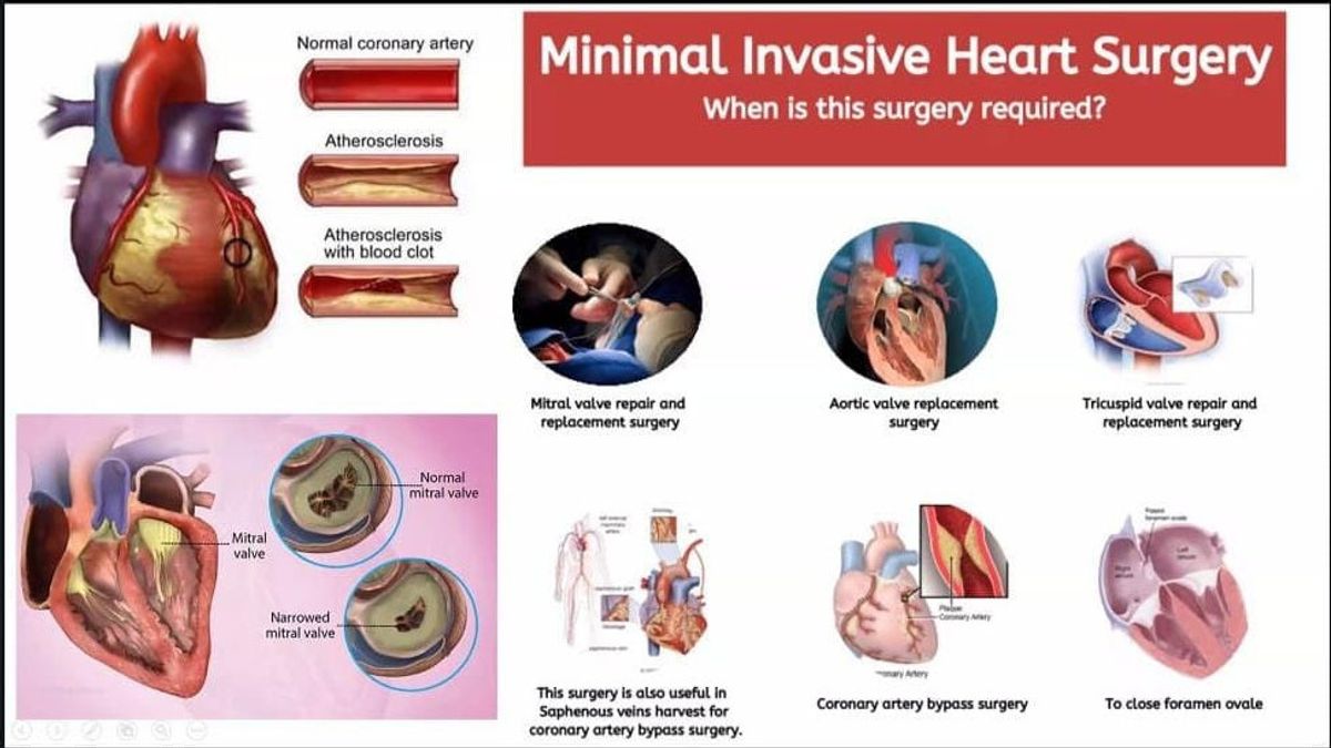 Pertama di Indonesia, Heartology Cardiovascular Hospital Catat Tindakan MICS Kombinasi
