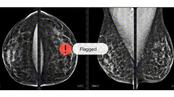 Partnering with iCAD, Google Health Helps Improve Breast Cancer Screening