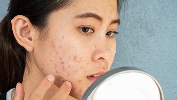 How To Remove Stone Acne That Appears In The Face Area