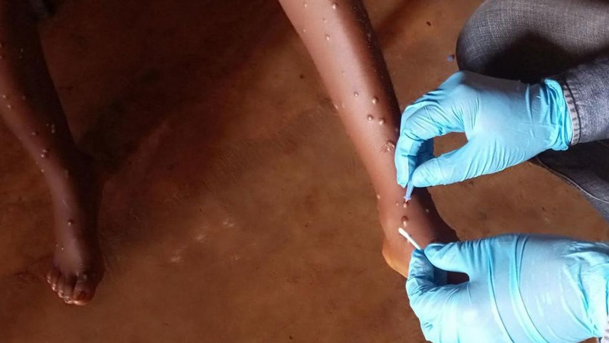 UNICEF Files 16.5 Million US Dollars Handling Mpox In Africa