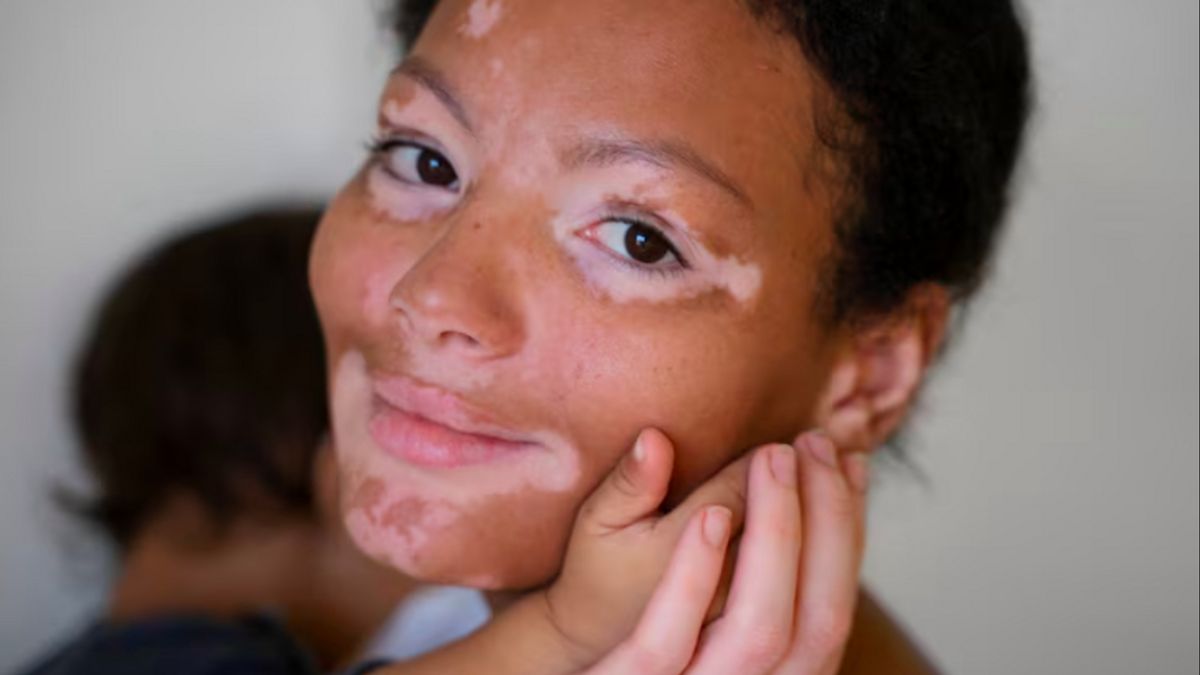 illes blanches sur la peau? Détecter les symptômes de vitiligo et le traitement
