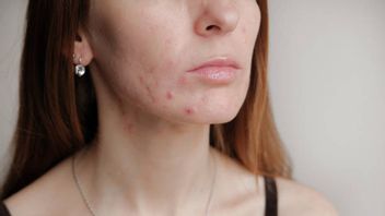 Know What Is Stress Acne And How It Is Different From Hormonal Acne