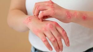 Cara Agar Cacar Air Cepat Keluar Semua​ dan Kering