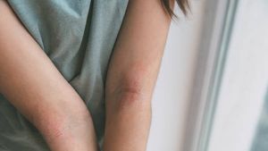 Deretan Makanan yang Sebaiknya Dihindari Penderita Eksim