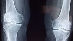 7 膝盖作斗骨的功能和诱性健康问题