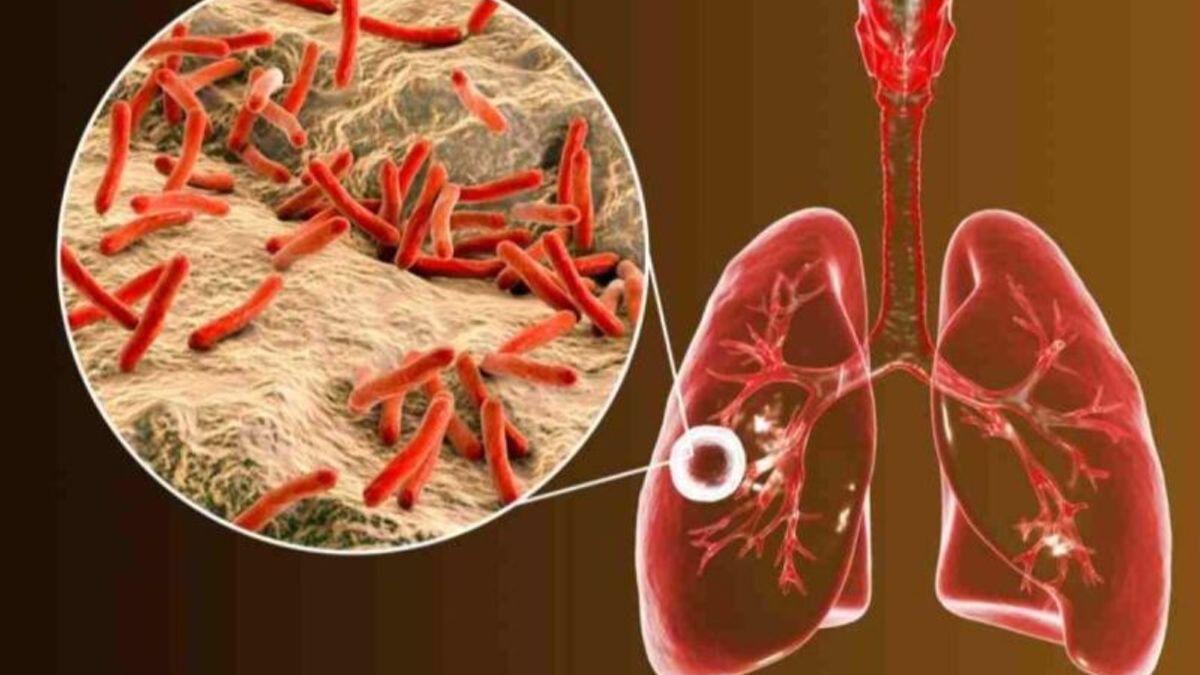 Comment transmettre la tuberculose, comment prévenir, aux symptômes