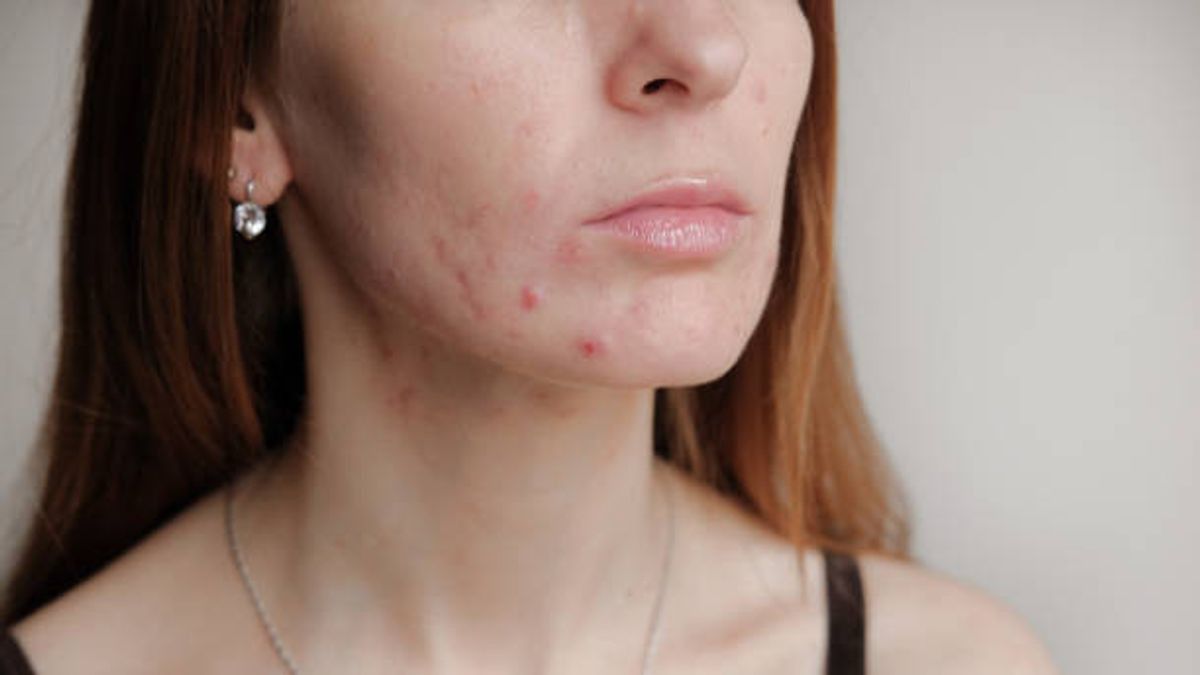 The Causes Of Acne In Dagu And How To Overcome It, Small But Perturbed!