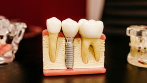 Raisons importantes des faux dents, plutôt que d’être autorisés à manger