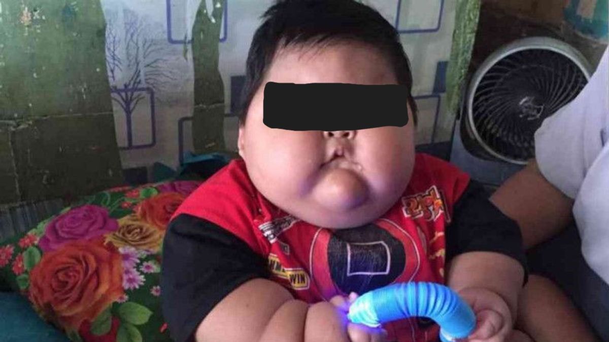卫生部长要求勿加泗的16个月大的肥胖幼儿接受治疗：必须由BPJS覆盖