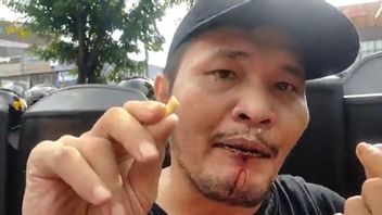 Mulut Berdarah Sembari Pegang Giginya yang Copot, Nicho Silalahi: Aku Jadi Korban Pemukulan Polisi