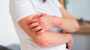 10 Effective Ways To Reduce The Desire To Snatch The Skin On Eczema Sufferers