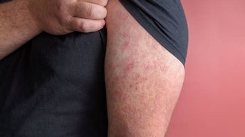 Campak Cases In Europe Increase Drastically, Highest In The Last 25 Years