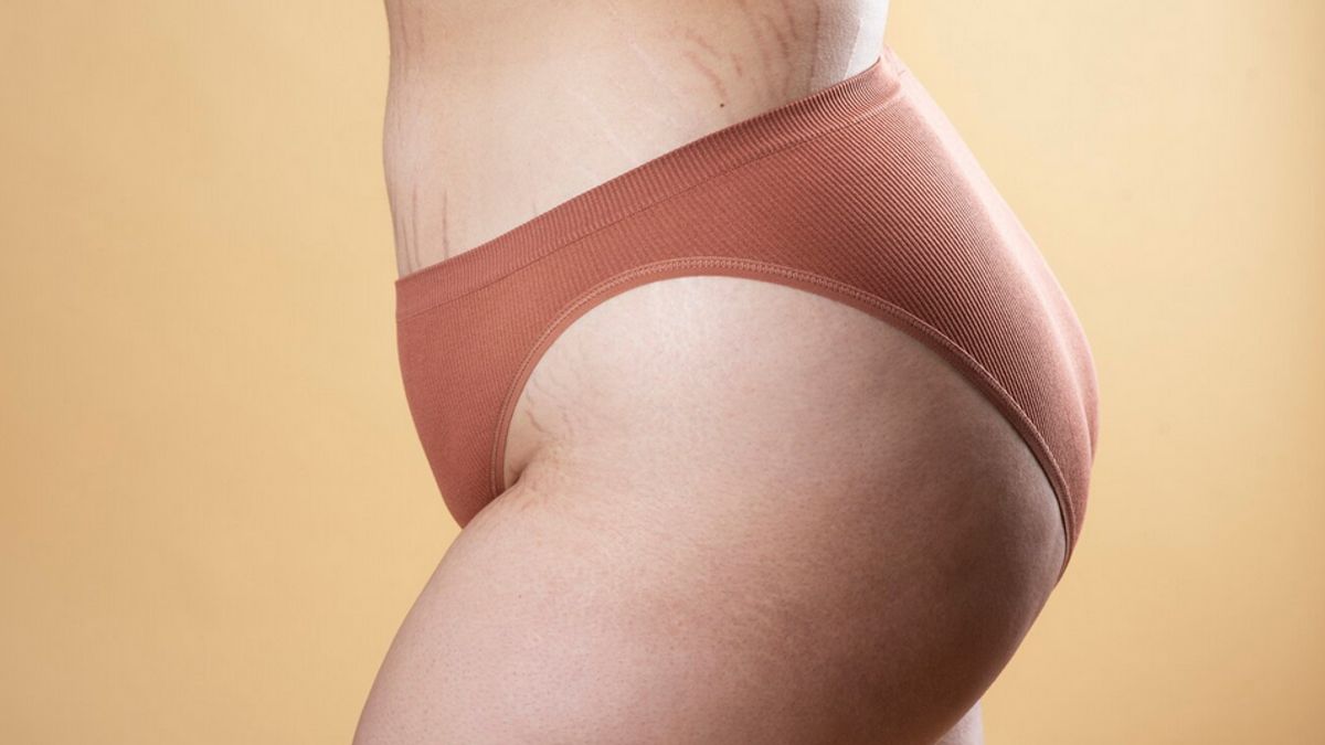 Mengenal Warna <i>Stretch Mark</i> serta Penyebabnya, Sudah Tahu Caranya Mengatasi?