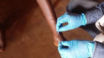 DIY Health Office Beware Of Post-Dispute Monkeypox Found 2 Alleged Cases