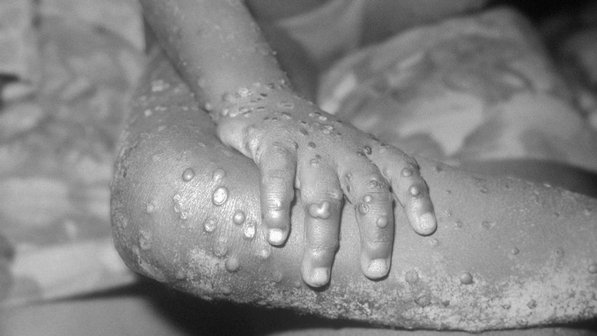 Monkeypox Cases Continue To Rise, United States Expands Testing Capacity