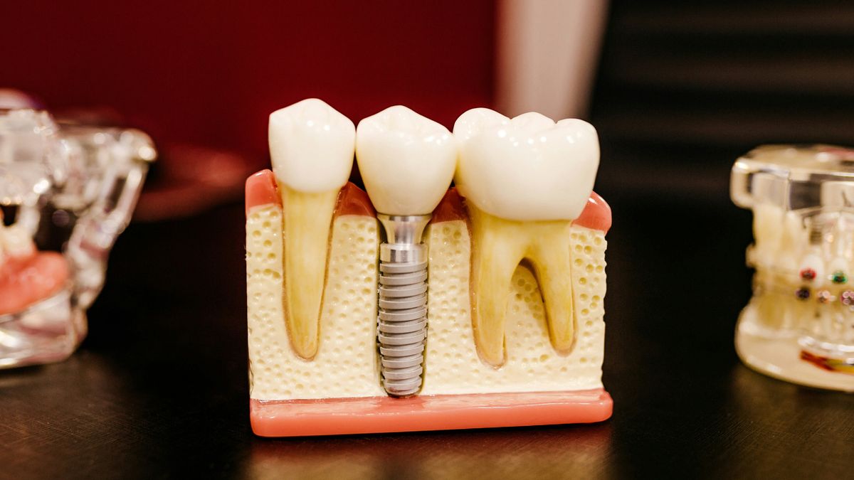 Raisons importantes des faux dents, plutôt que d’être autorisés à manger