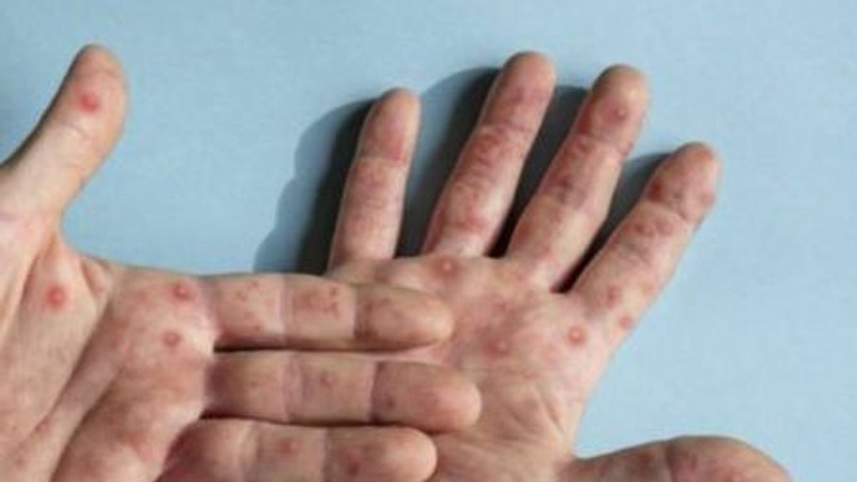 411 People In Jakarta Have Been Vaccinated With The Second Dose Of Monkeypox