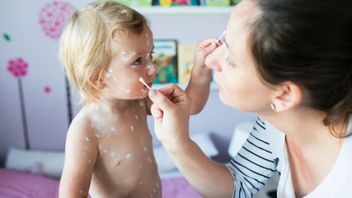 高感染率、インドネシアの天然痘症例の増加に注意してください