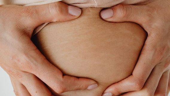 Penyebab dan Cara Menghilangkan Stretch Mark yang Cukup Mengganggu Penampilan Tubuh