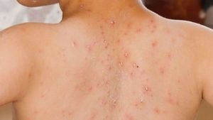 Apakah Penderita Campak Boleh Mandi​? Boleh, Asal Perhatikan Hal ini