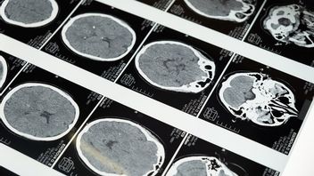 Tukul Arwana Didiagnosis Terkena Pendarahan Otak, Segera Kenali Penyebabnya