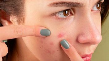 Immediately Stop It, These 4 Habits Can Make Acne Worse