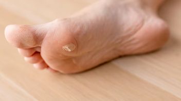 Cara Menghilangkan Kapalan di Kaki​ Secara Mandiri di Rumah