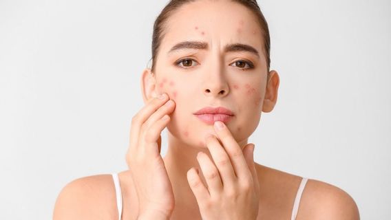 How to Treat Acne During Menstruation that is Simple and Effective