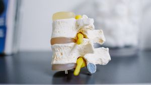 Penyebab Pengapuran Tulang Belakang di Usia Muda, Apakah Bisa Disembuhkan?