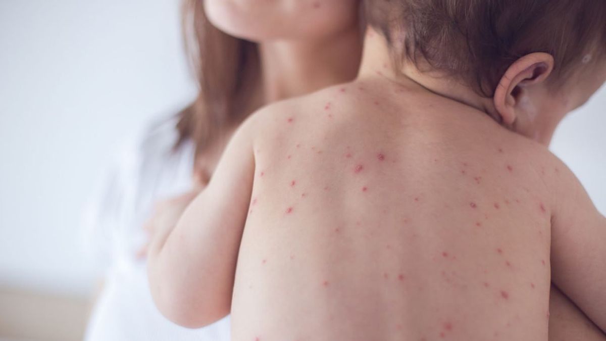 rénal : les parents doivent savoir : Voici les 8 signes de la maladie cutanée chez les enfants