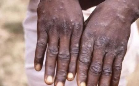 Lebih Jelas Soal Wabah Monkey Pox, Pengertian, Gejala, Hingga Cara Mengatasi