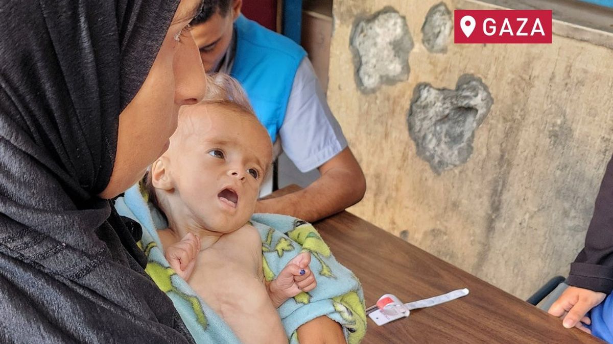 Klinik di Gaza soal Kasus Malnutrisi Meroket: Ini Kelaparan yang Disengaja Otoritas Israel
