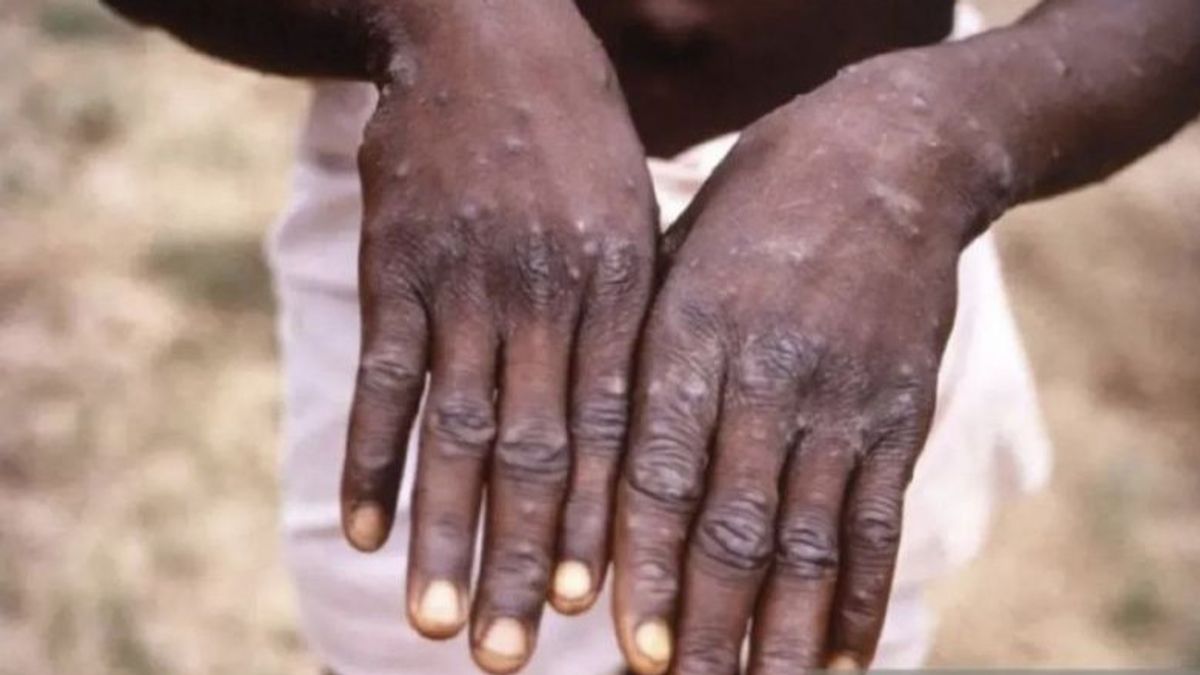 6 Monkeypox Cases In Jakarta Proposed By Bisexual