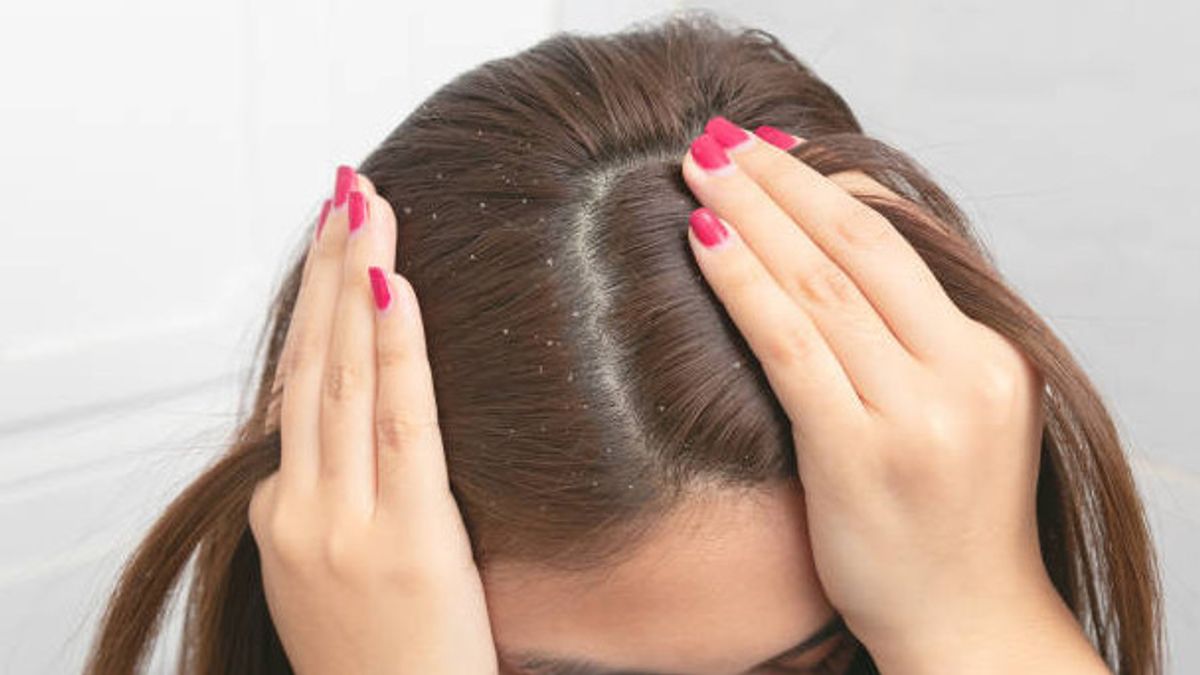 Behind the Dandruff Cloud, Are Scalp Flakes Really a Trigger for Hair Loss?