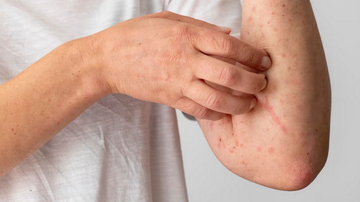 Tanpa Diduga, 7 Hal Ini Bisa Memicu Alergi