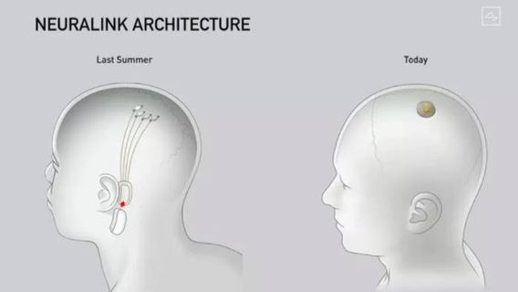 イーロンマスクのノイラリンクは、FDAの緑色のライトである人間の脳にすぐに植え付けます!